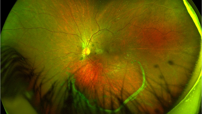 An 8-year-old with mild myopia presents with sudden visual loss. The fundus findings are striking but the real question is not just how to treat, but why it happened…