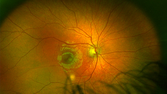 A rare syndrome revealed by large eyes and high myopia