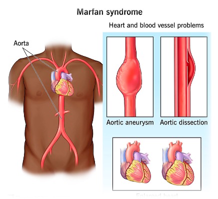 Cardiac involvement   Echocardiography report:Mitral valve prolapse (MVP) with moderate mitral regurgitation  Aortic regurgitation and dilatation