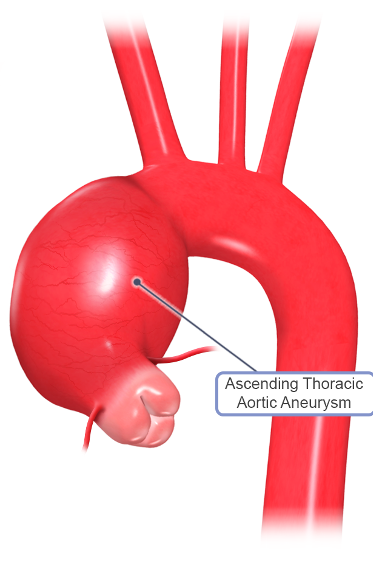 FBN1 gene mutation: FBN1: connective tissue disorder  Cardiovascular manifestations:       Aortic root dilatation     Mitral valve prolapse     Aortic aneurysm