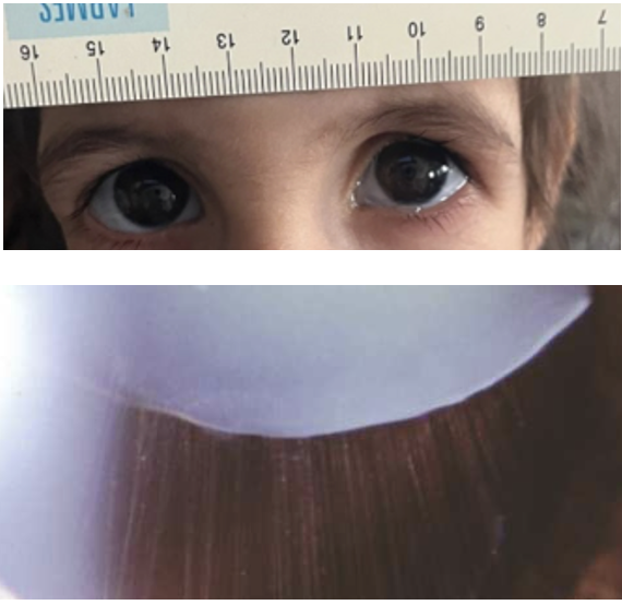 Very early onset presentation.  Ophthalmological findings: Megalocornea Iridodonesis Ectopia lentis High Myopia Glaucoma