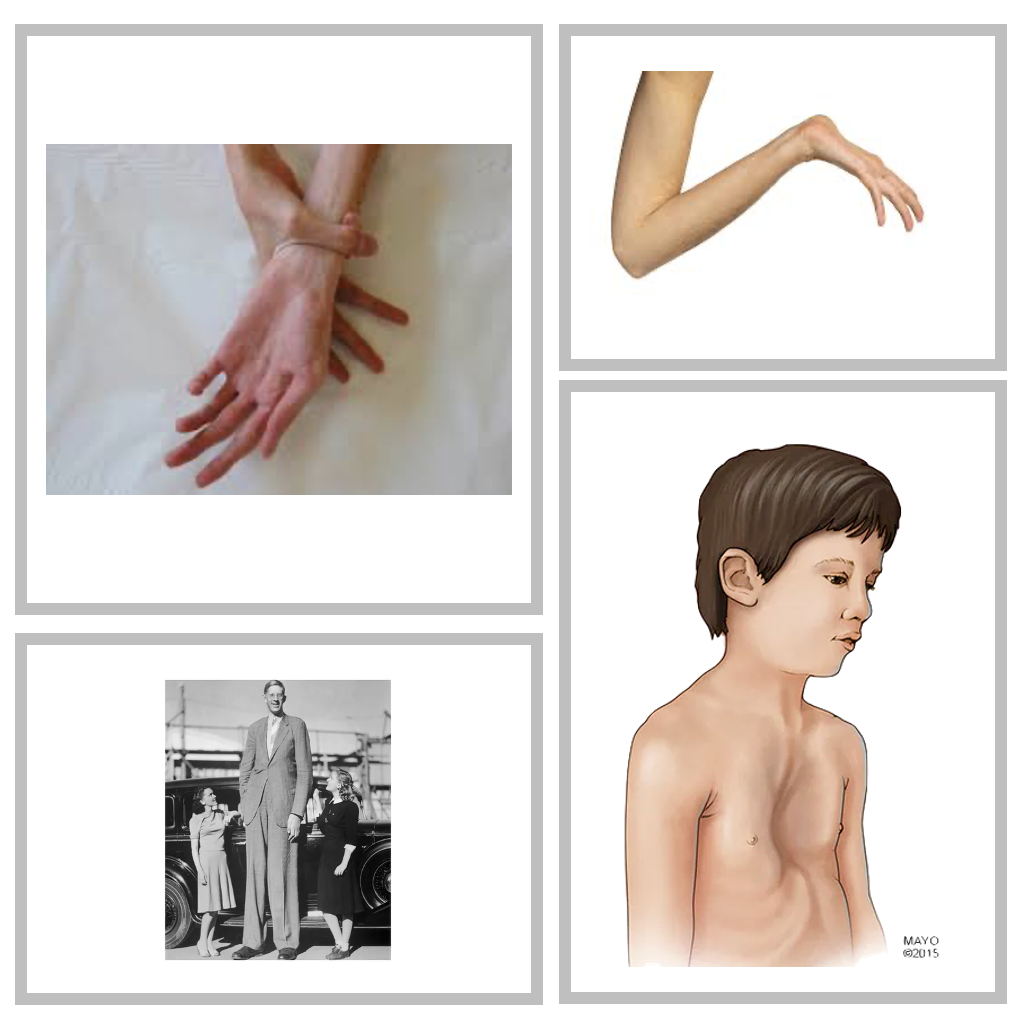 Musculoskeletal manifestations: 