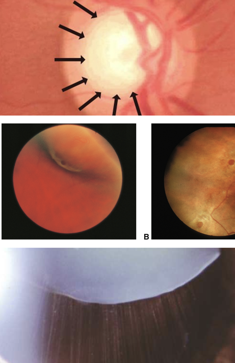 Ophthalmological manifestations:       Ectopia lentis bilateral (80% of cases); subluxation (anterior chamber; vitreous)     Myopia +/- astigmatism (lens-related); severe and progressive course     Angle anomaly: glaucome Cataract     Lattice retinal degeneration: risk of retinal detachment