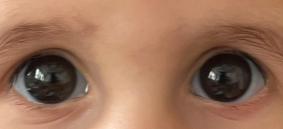 A rare syndrome revealed by large eyes and high myopia