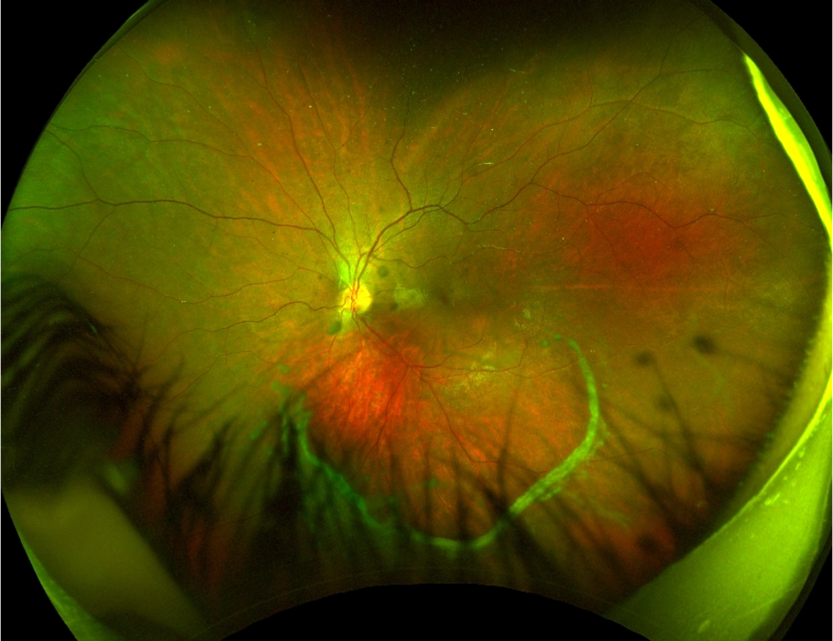 Right eye