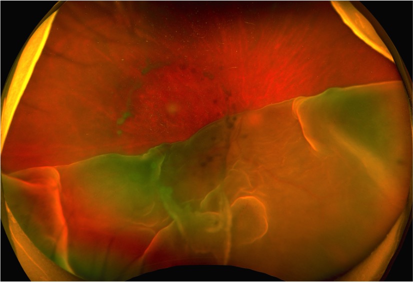 Right eye