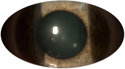 => Not an axial myopia… Refractive myopia => cornea, or lens