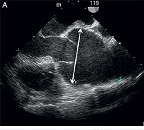75% mortality rate at 3 years