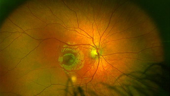 A rare syndrome revealed by large eyes and high myopia